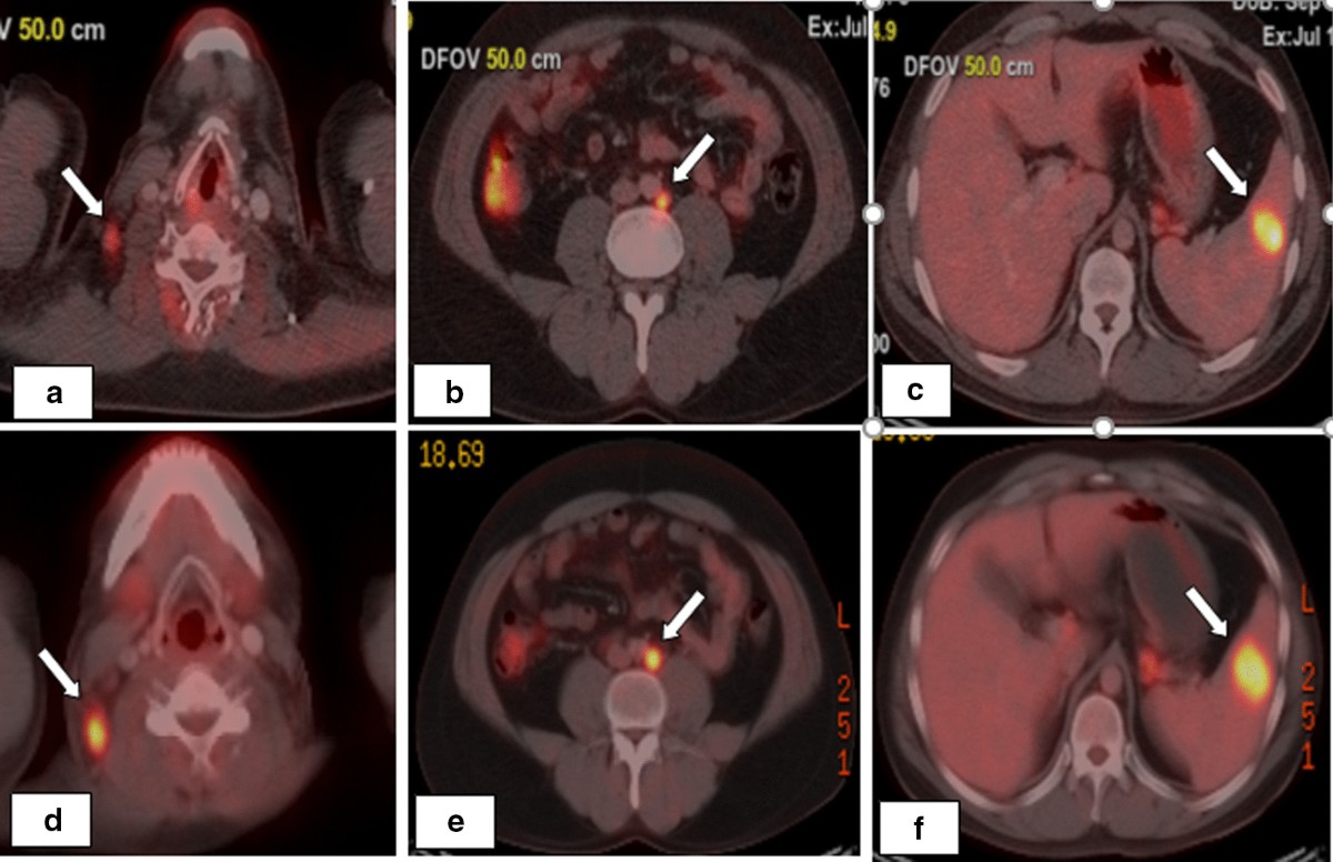 Positron emission tomography (PET) imaging during chemotherapy to predict outcome in adults with Hodgkin lymphoma